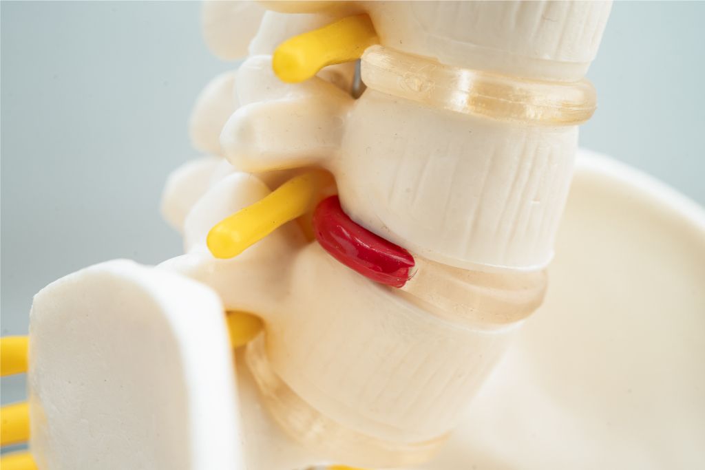 Entrenar con hernia discal